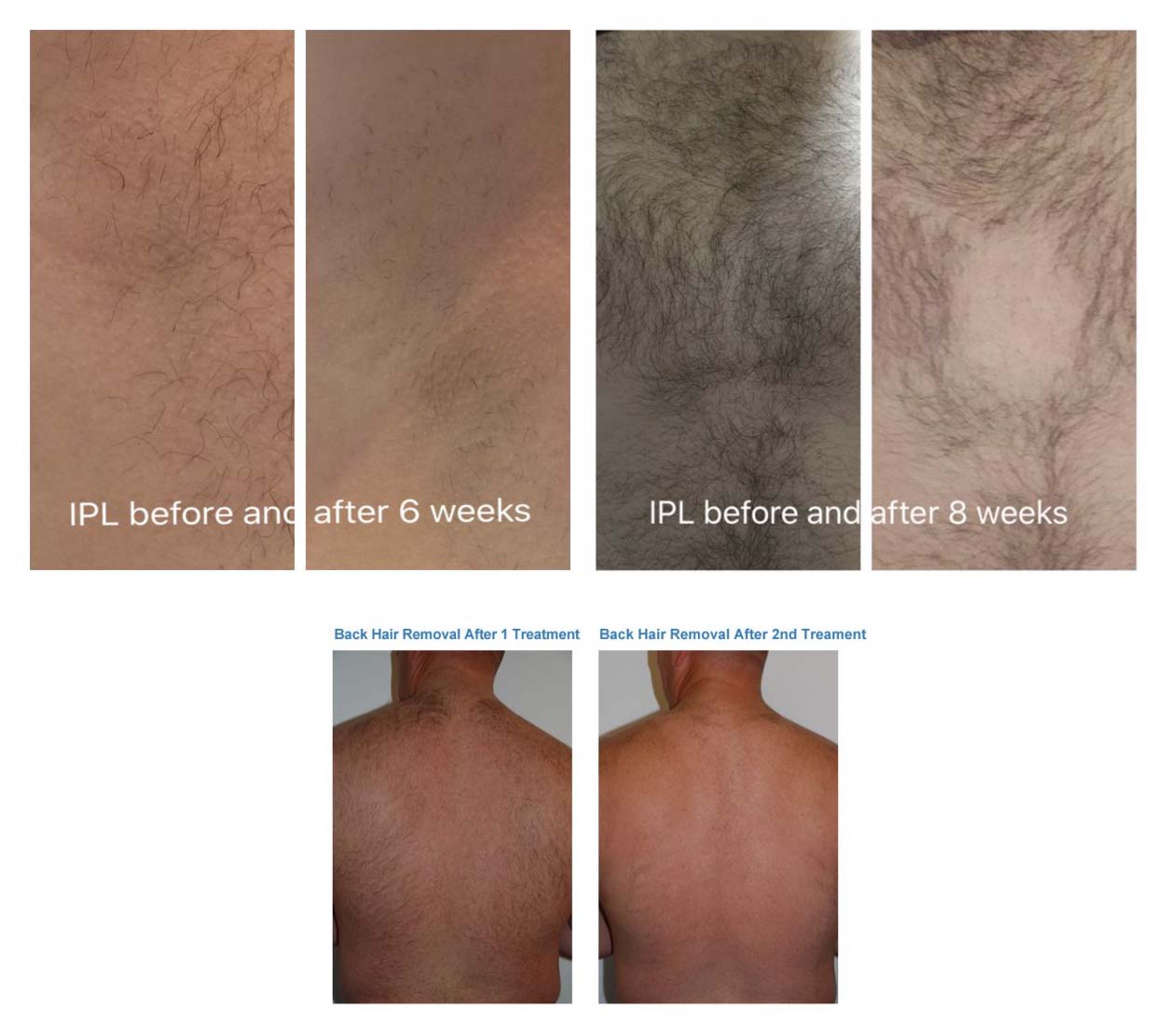 Hair Removal Hinckley
